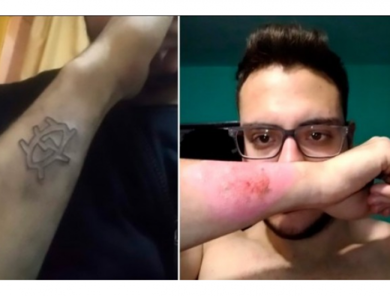 Лазер ли? Млад мъж премахна татуировката си с... ренде СНИМКИ