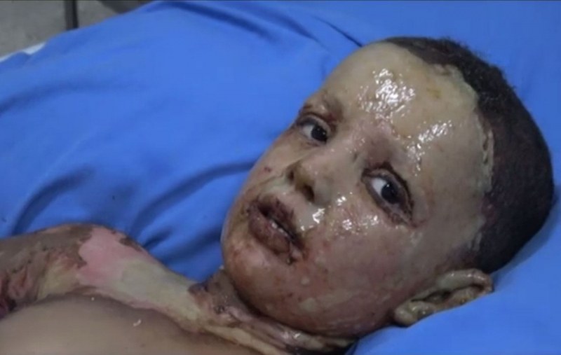 Лицето на войната в Сирия – турски химически оръжия срещу кюрдски деца!?