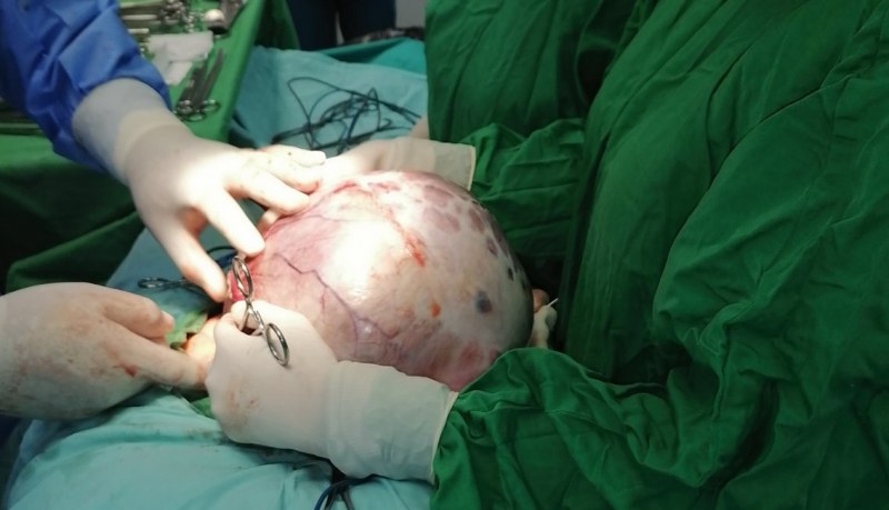 Златни им ръце: Лекари извадиха 12-килограмов тумор от жена