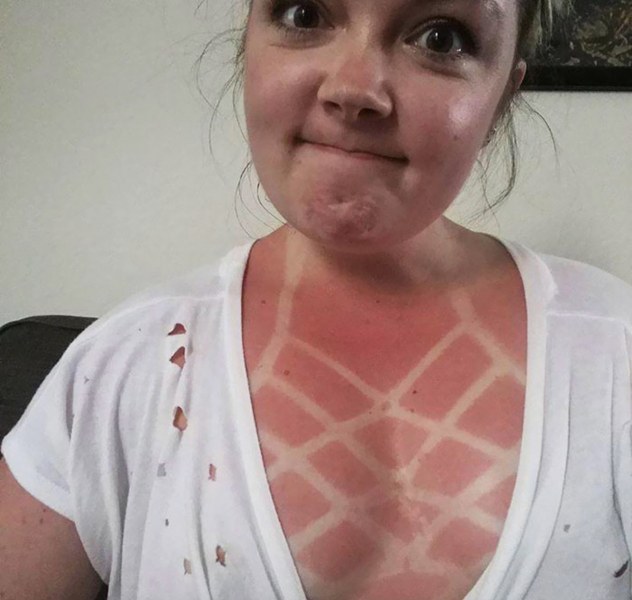 Най-абсурдните слънчеви изгаряния на хора СНИМКИ