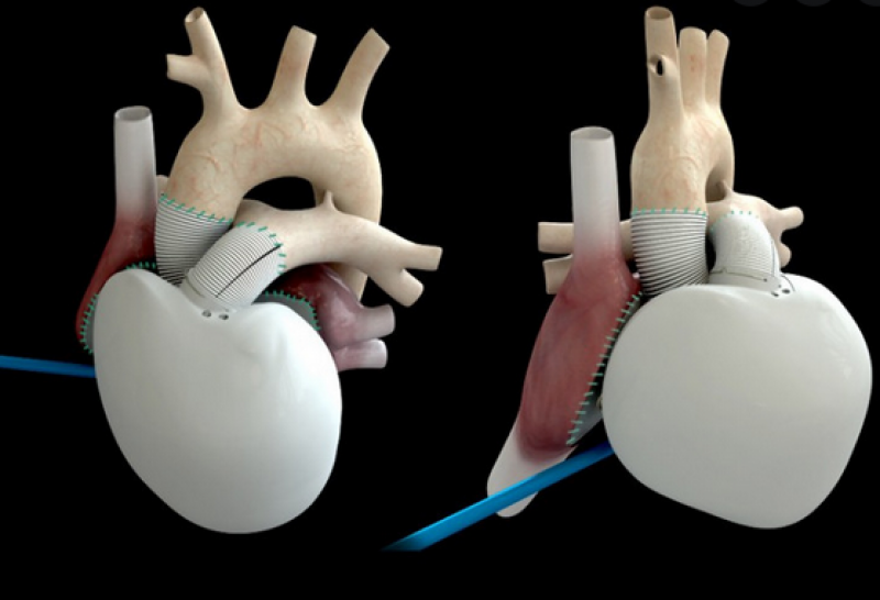 Лекари трансплантираха изцяло изкуствено сърце на човек
