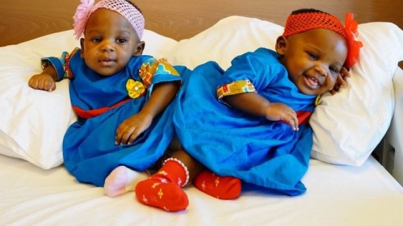 Успешна операция: Разделиха сиамски близнаци след 27 часа очакване