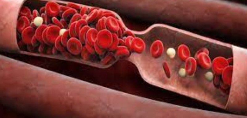 Има ли връзка между тромбообразуването и гъстотата на кръвта?