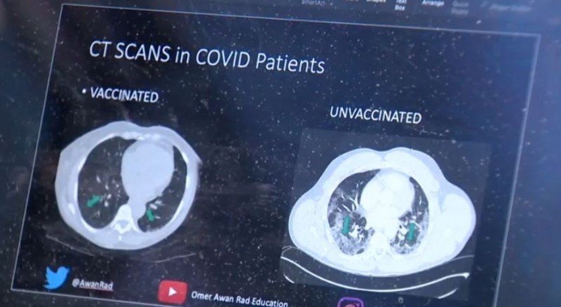 Лекар показа рентгенови снимки на гръден кош на ваксиниран и неваксиниран