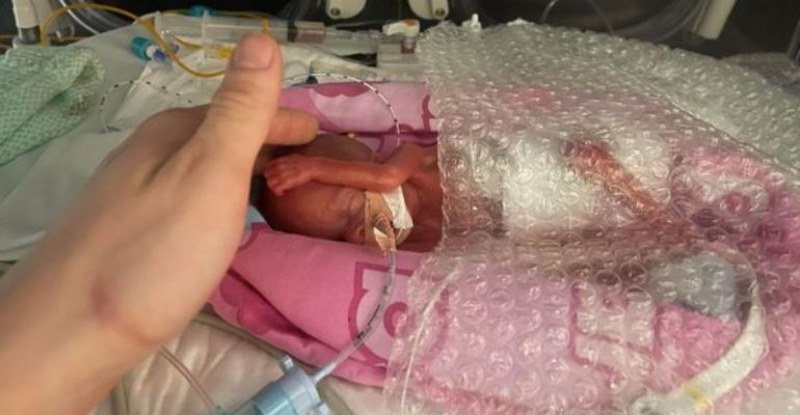 С 20% шанс за живот! Най-малкото недоносено бебе на Острова - оцеля СНИМКИ