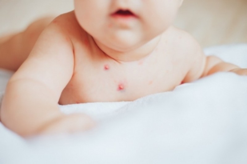 Ръст на болни от варицела при децата в Пловдив