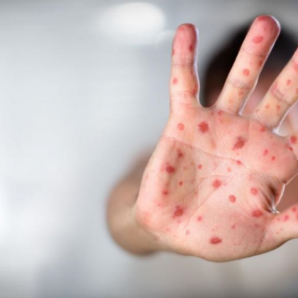 Първи предполагаем случай на маймунска шарка е открит в Гърция