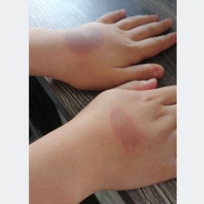 10 годишна момиче пострада сериозно след поредното TikTok предизвикателство Момичето било
