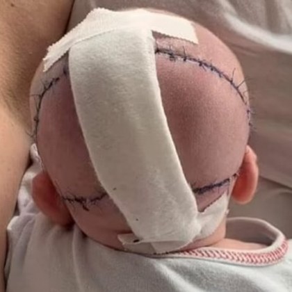 Полски специалисти направиха иновативна операция на момиче което се роди