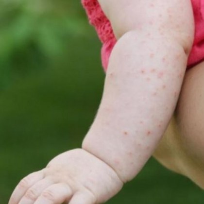 Обхватът с ваксините срещу морбили в София град е намалял