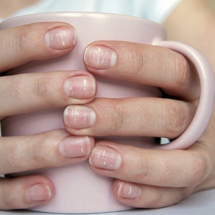 Наличието на бели петна върху ноктите е един от най често