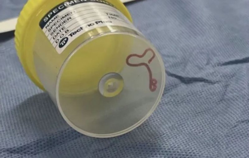 Жив червей беше открит в мозъка на жена в Австралия