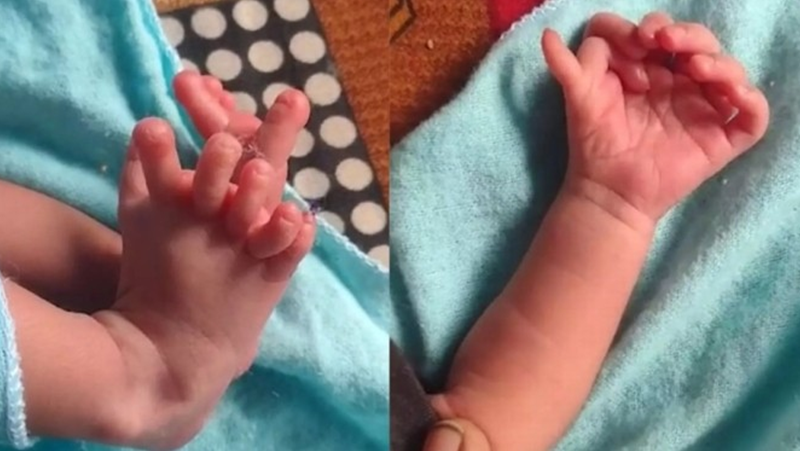 В Индия се е родило бебе със седем пръста на