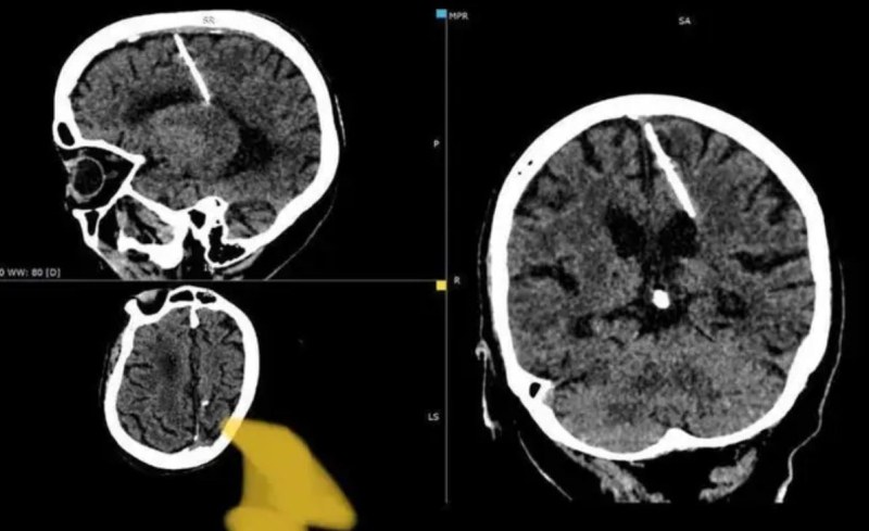 Лекари откриха игла в главата на жена