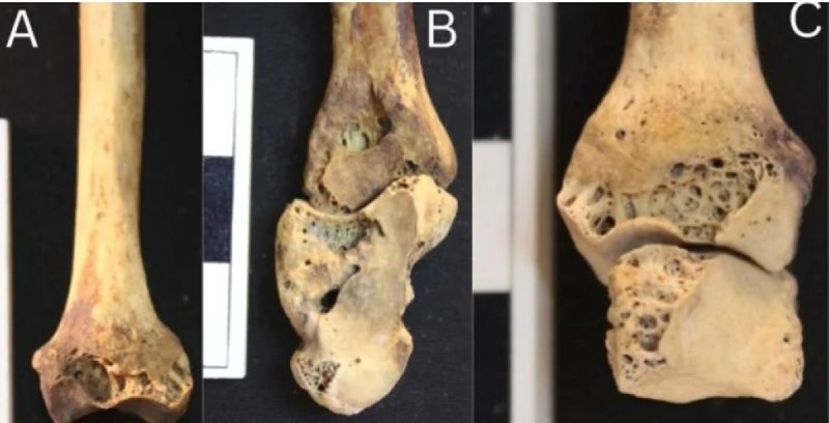 Откриха опасна болест в скелет на 3500 г. СНИМКИ