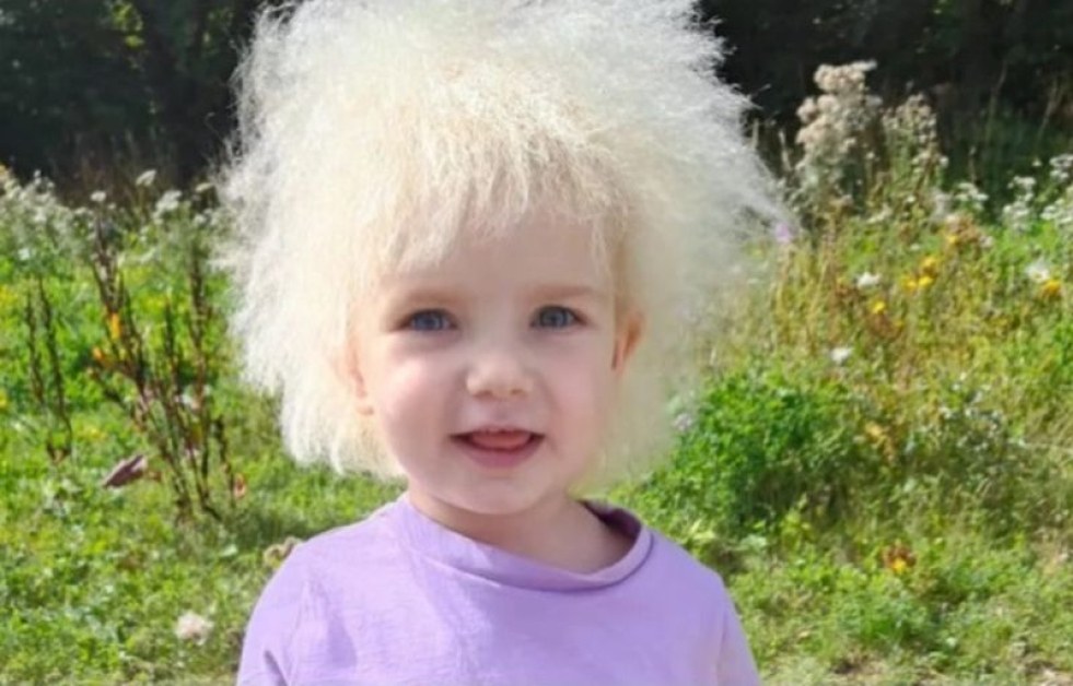 Как живее 3-годишно момиченце със синдром на разрошената коса СНИМКИ