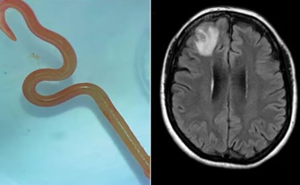 Мистериозно главоболие: Лекари откриха рядък паразит в мозъка на мъж