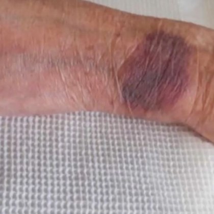 104 годишната жена изписана от болница във Видин със синини е