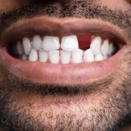 Лекарство което възстановява зъбите може да бъде на пазара до