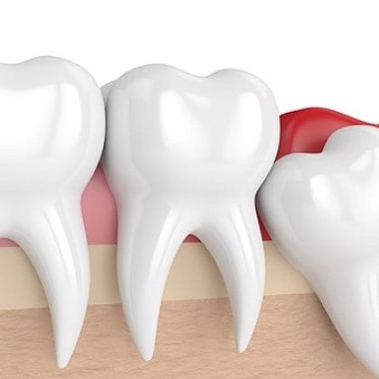 Мъдреците или третите кътници са последните зъби които поникват в