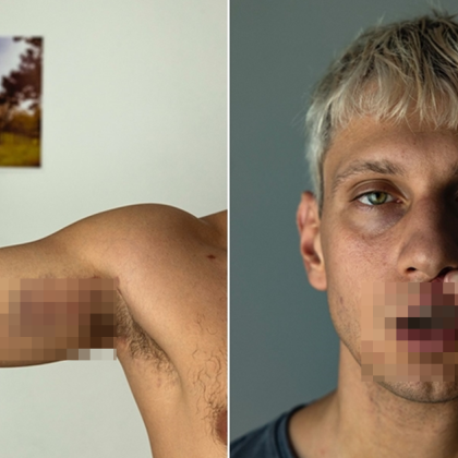 Млад мъж твърди че е бил нападнат и жестоко пребит