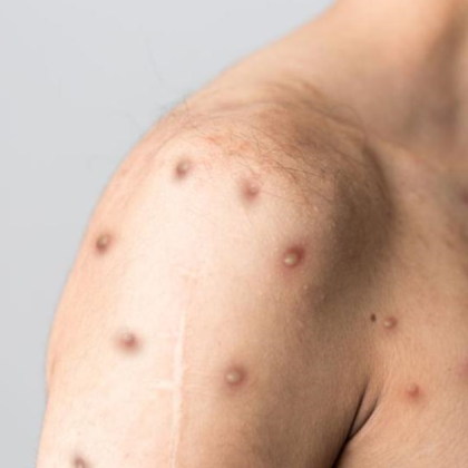 Европейският център за превенция и контрол на заболяванията ECDC повиши нивото