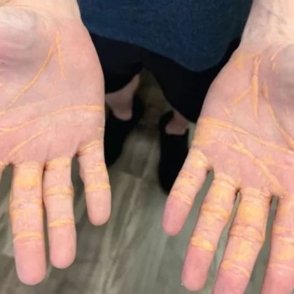 Мъж от Тампа Флорида започна да отделя парчета холестерол през