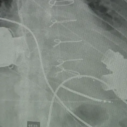 За втори път у нас поставиха две изкуствени сърца на