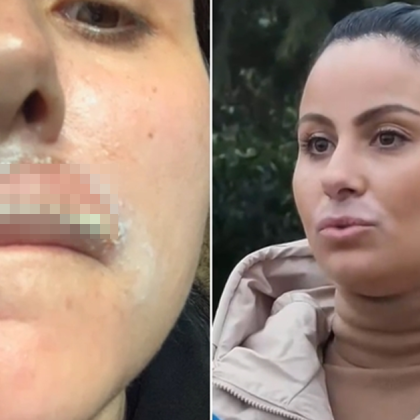 Жена твърди че е обезобразена след дерматологична процедура с лазер