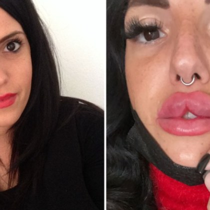 Българска лекарка е обезобразила италианката Федерика Фуни За случая разказва тя