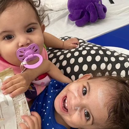 Сиамски близначки от Бразилия родени със сраснали гърди корем и