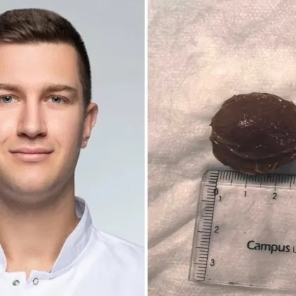 Лекарите от Клиниката по гастроентерология на УМБАЛ Каспела успешно отстраниха