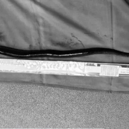 Китайски лекари откриха жива 30 сантиметрова змиорка в стомаха на мъж