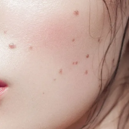 В един свят пълен с уникални черти бенките по лицето