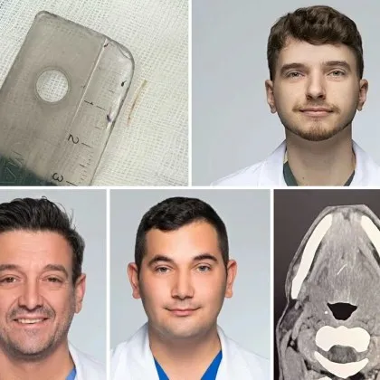 Лекари извършиха успешно отстраняване на рибена кост заседнала дълбоко в