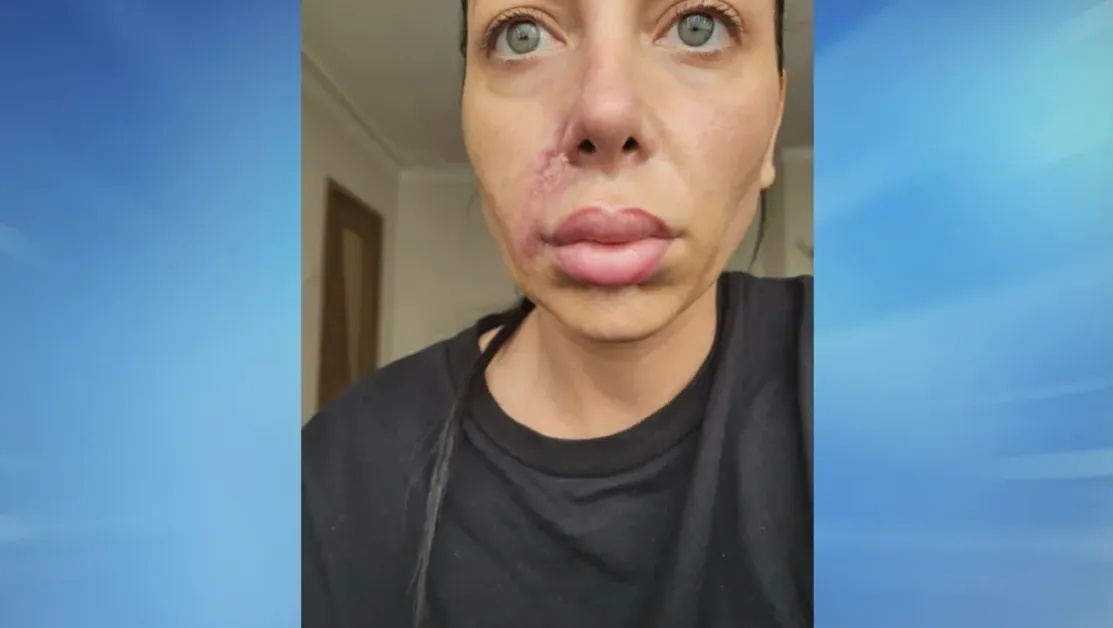 Лицето на жена се изкриви след поставяне на хиалуронов филър