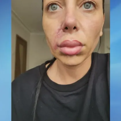 Лицето на жена се изкриви след поставяне на хиалуронов филър Лицето на жена се изкриви след поставяне на хиалуронов филър