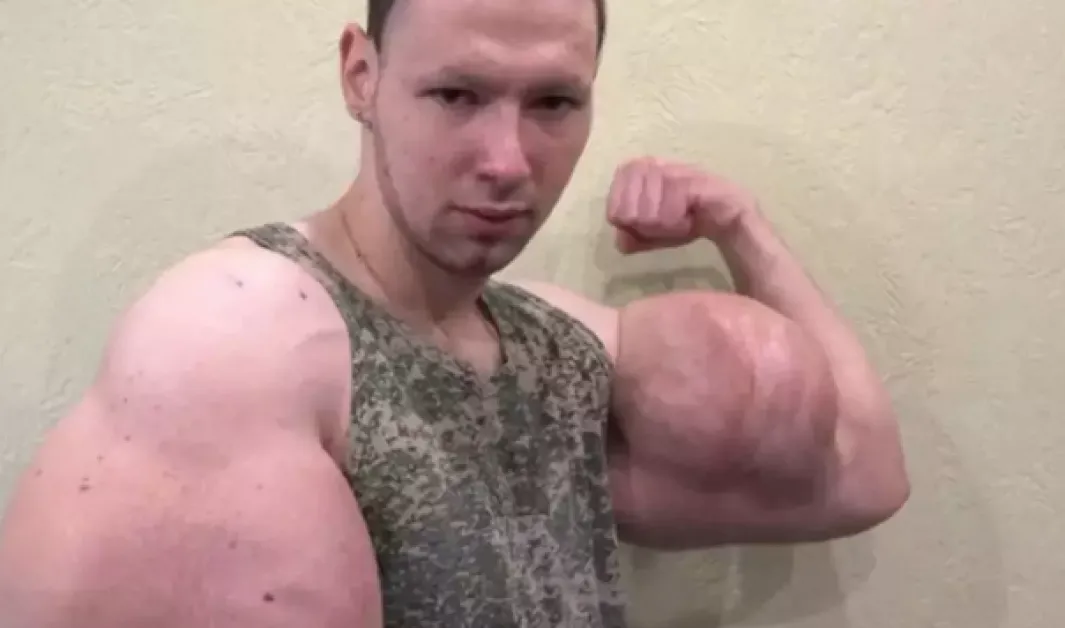 „Руският Попай" може да загуби двете си ръце