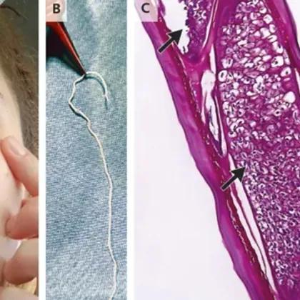 Паразит се е крил под кожата на 26 годишна жена в