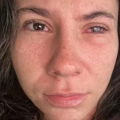 Паразит остави млада жена без зрение в едното око