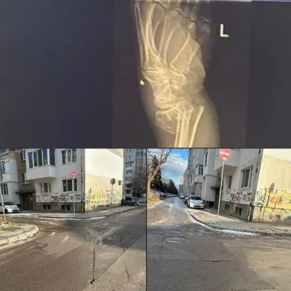 Жена падна и счупи лошо ръката си, ще съдят София за безхаберието