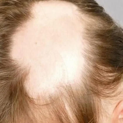 Учени откриха, че COVID-19 може да доведе до оплешивяване