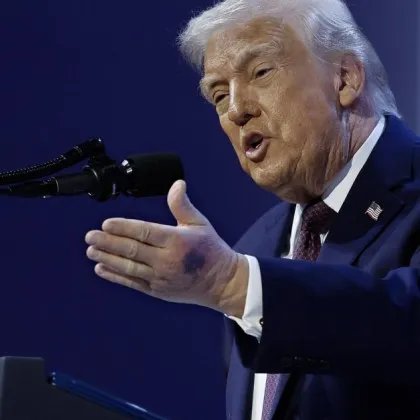 Президентът на САЩ Доналд Тръмп коментира появата на ужасни синини