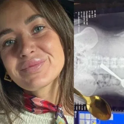 Млада жена глътна 17-сантиметрова лъжица, намесиха се медици СНИМКИ