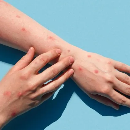 Сериозна епидемия от морбили е регистрирана в северния лондонски квартал