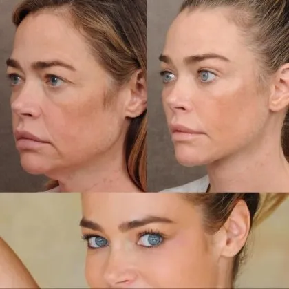 Известна актриса е неузнаваема след пластична операция СНИМКИ