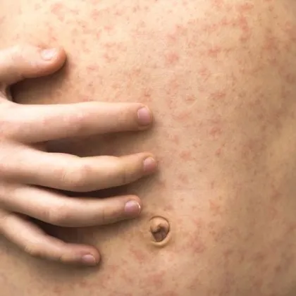 43 случая на морбили у нас