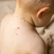 Ръст на случаите на морбили у нас