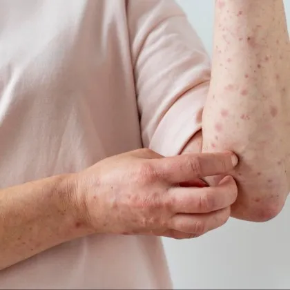 Общо 73 са регистрираните случаи на морбили у нас