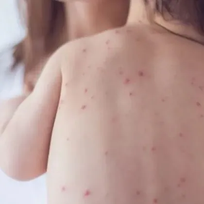 Разкриха броя на заболелите от морбили, над 89% са деца